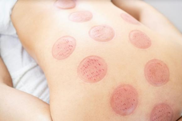 Hijama par ventouses