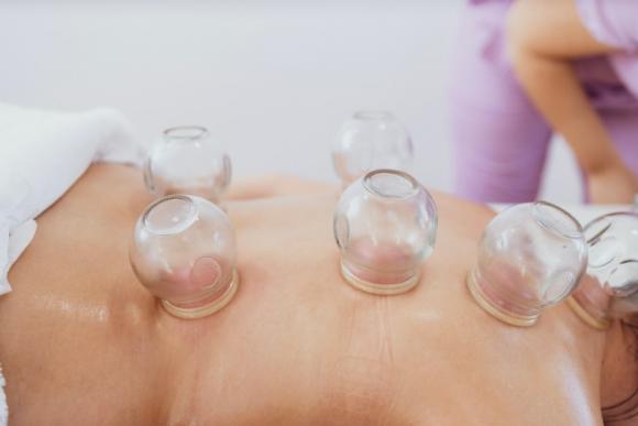 Cupping therapy